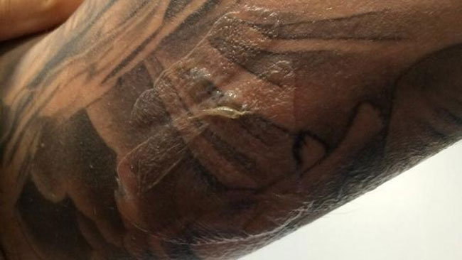 Hector Barbera posta la foto del suo braccio bruciato